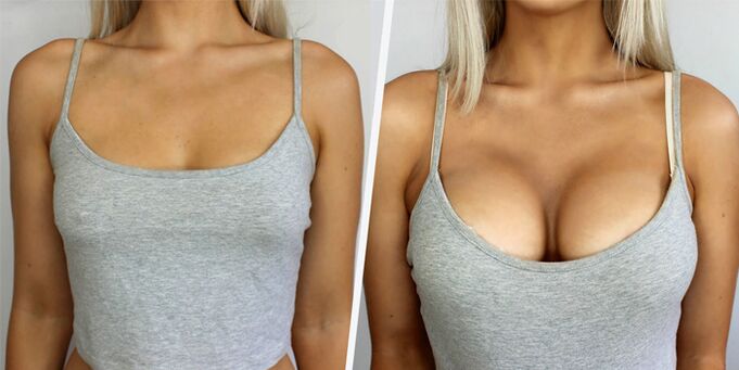 enne ja pärast rindade suurendamise plastilist operatsiooni