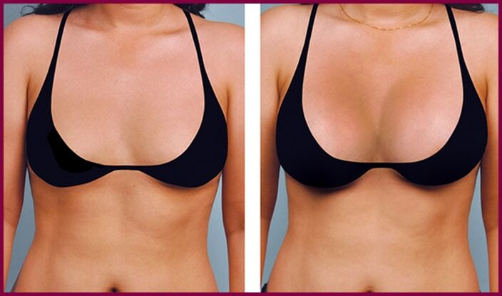 enne ja pärast rindade suurendamist rasvaga