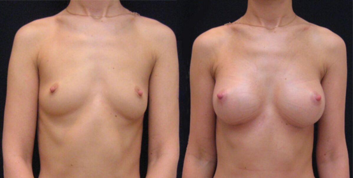rindade enne ja pärast endoskoopilist suurendamist