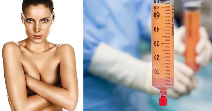 lipofilling kui rindade suurendamise meetod