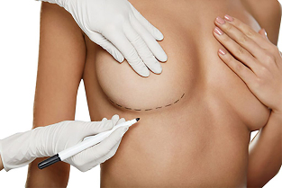 Markeri märkimine enne rindade suurendamise operatsiooni